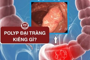 7 Nhóm Thực phẩm Người Bị Polyp Đại Tràng Nên Tránh Xa